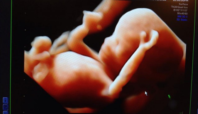 Ultrasound technology has come so far in the past 20 years. This is a 4D picture from a pregnancy centre of an 11-week-old baby in the womb. Photo source - https://www.facebook.com/abbyjohnsonprolife/photos/a.671232512886825.1073741825.114382035238545/882244675118940/?type=1&theater