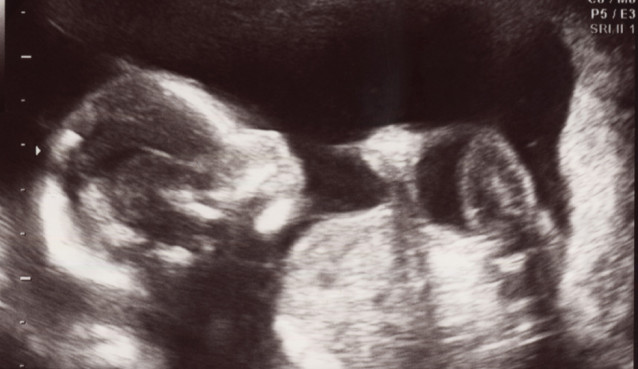 Ultrasound photo of a human embryo at 18 weeks from conception showing the child's head