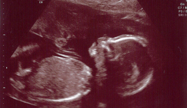 Ultrasound at 20 weeks. Used under CC Licence. https://flic.kr/p/acdWPT
