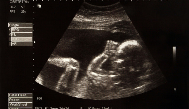 Ultrasound photo of a human embryo at 24 weeks from conception
