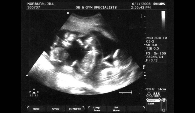 Ultrasound of Triplets show all 3 babies. https://www.flickr.com/photos/jillstriplets/2573463110/