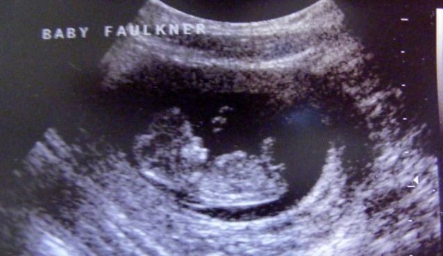 Ultrasound photo of a human embryo at 9 weeks from conception. Used under CC Licence. http://www.flickr.com/photos/11240041@N08/2331642092. 