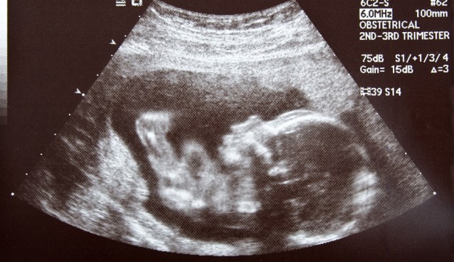 Ultrasound photo of a human embryo at 17 weeks from conception