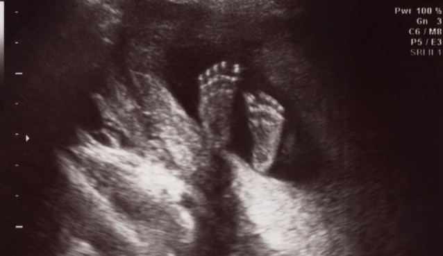 Ultrasound photo of a human embryo at 18 weeks from conception showing the childs feet