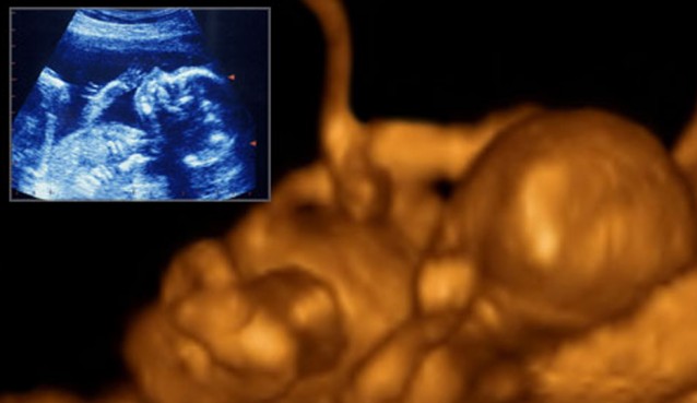Ultrasound photo of a human embryo at 20 weeks from conception