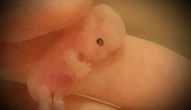 Mindy Raelynne Danison posted a photo of her tiny baby miscarried at 8.5 weeks