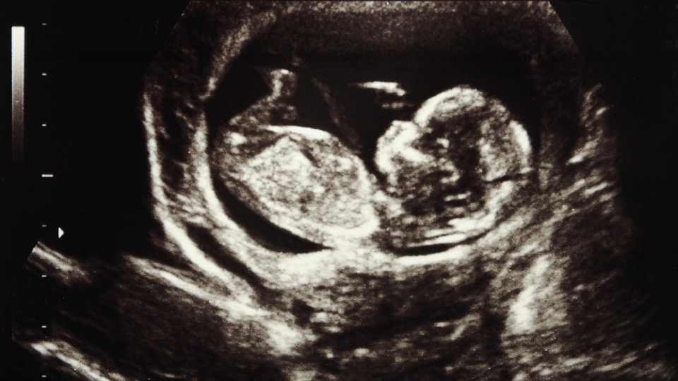 Ultrasound photo of a human embryo at 13 weeks from conception