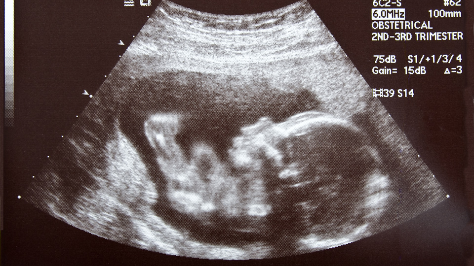 Ultrasound photo of a human embryo at 17 weeks from conception