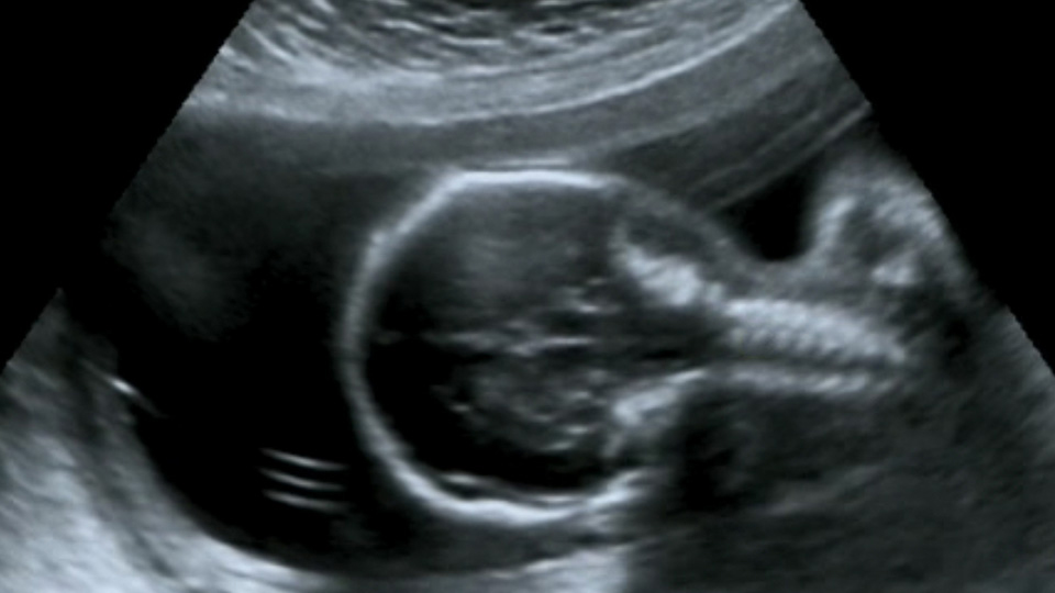 Ultrasound photo of a human embryo at 18 weeks from conception