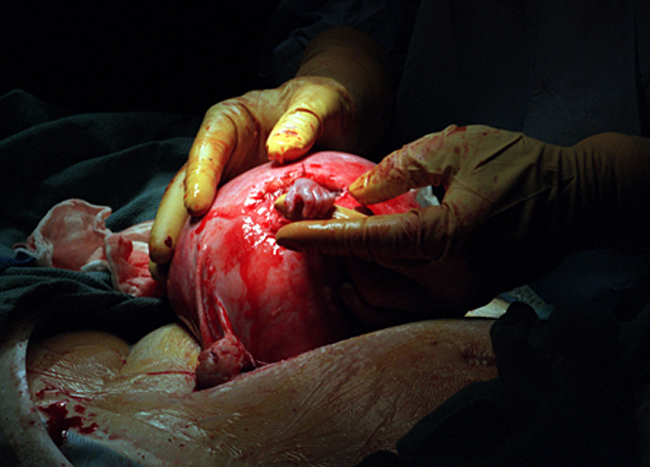 Samuel Armas is pictured during a risky surgery. He is a 21 week old foetus. This photo is known as the hand of hope and was republished all over the world