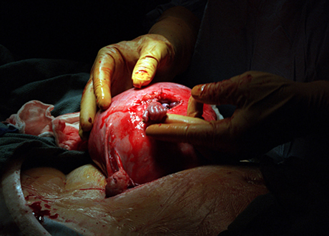 Samuel Armas is pictured during a risky surgery. He is a 21 week old foetus. This photo is known as the hand of hope and was republished all over the world