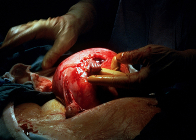 Samuel Armas is pictured during a risky surgery. He is a 21 week old foetus. This photo is known as the hand of hope and was republished all over the world